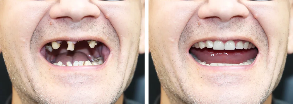 Zestawienie uśmiechu pacjenta przed i po metamorfozie. Po lewej stronie widoczne znaczne braki zębowe, po prawej pełna, estetyczna odbudowa protetyczna wykonana w Dental-Wit.