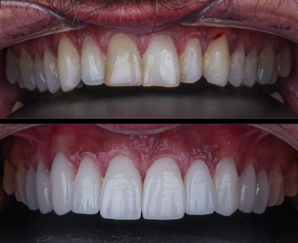 Zestawienie dwóch zdjęć uzębienia pacjenta przed i po leczeniu stomatologicznym, ukazujące spektakularną metamorfozę uśmiechu w klinice Dental-Wit.